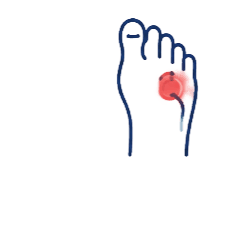 Recurrent gout attacks icon