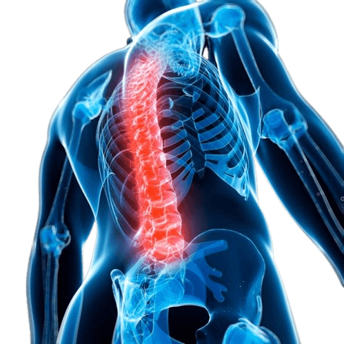 Illustration of ankylosing spondylitis affecting the spine