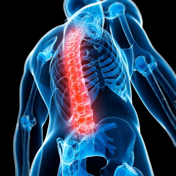 Ankylosing spondylitis spine illustration