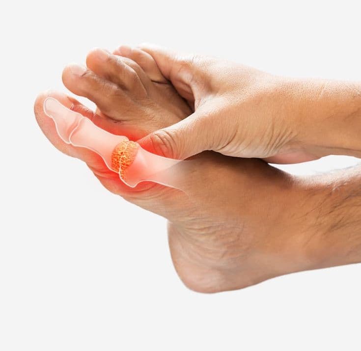 Gout big toe joint illustration