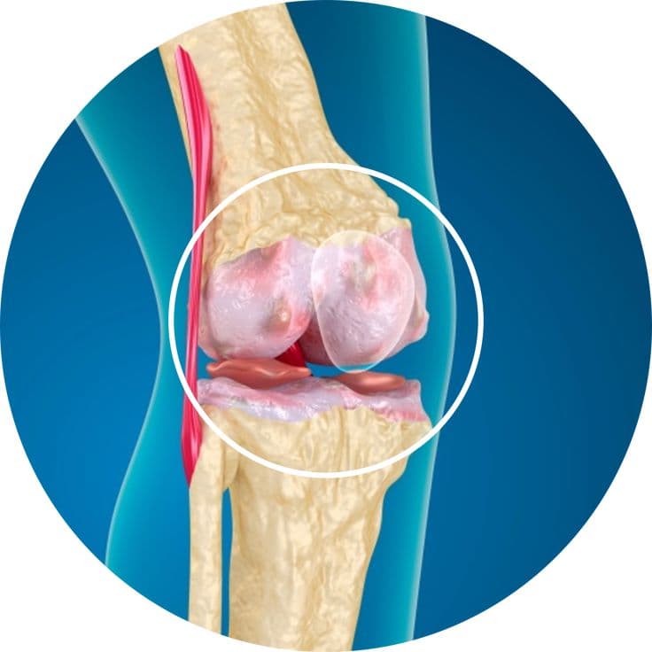 Osteoarthritis knee joint illustration