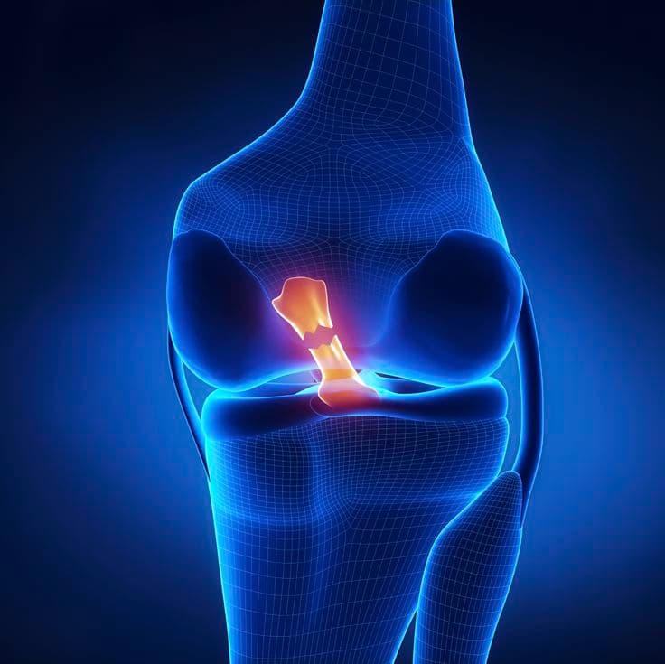 Septic arthritis knee infection illustration